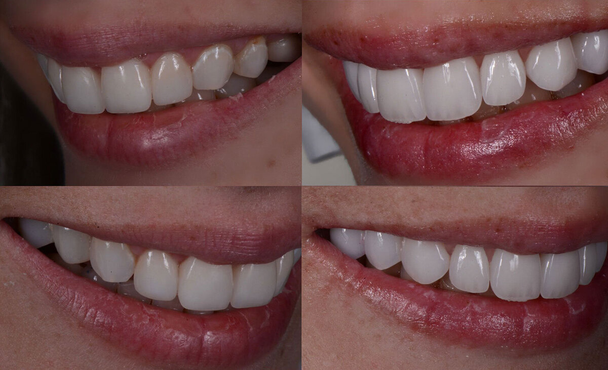 Patient smile transformation result at ELEV8 Dentistry, Beverly Hills