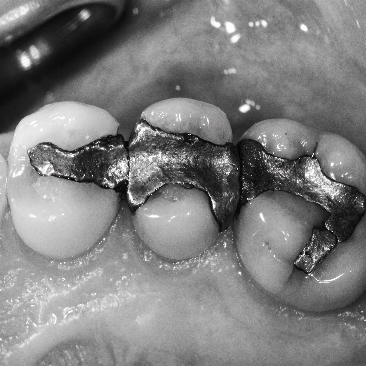 Safe mercury amalgam filling removal at ELEV8 Biological Dentistry, Beverly Hills