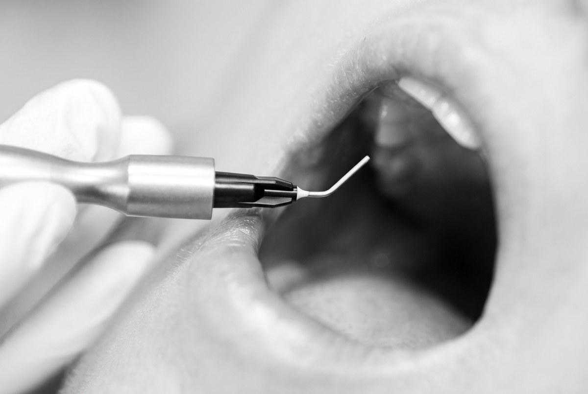 Ozone and Laser Therapy at ELEV8 Biological Dentistry, Beverly Hills