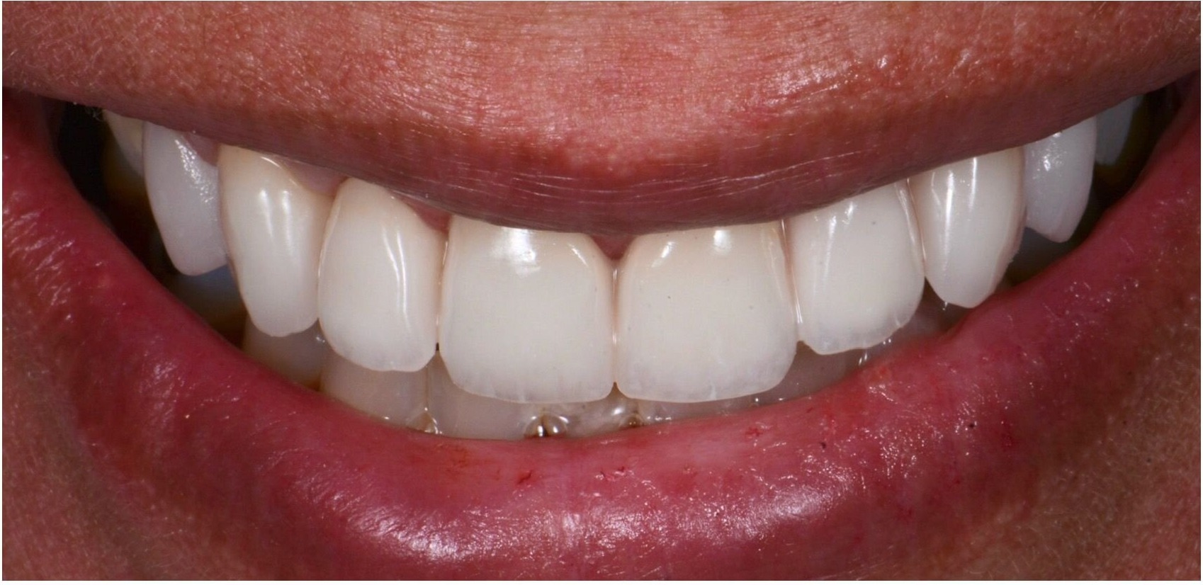 The same upper arch after treatment, complete and even