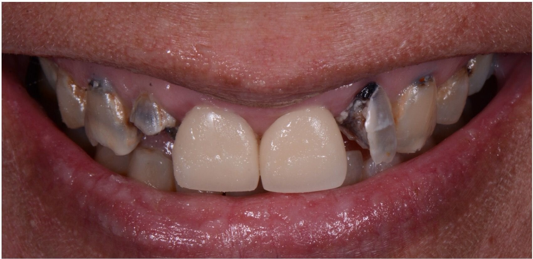 Extensive breakdown across the upper teeth before treatment