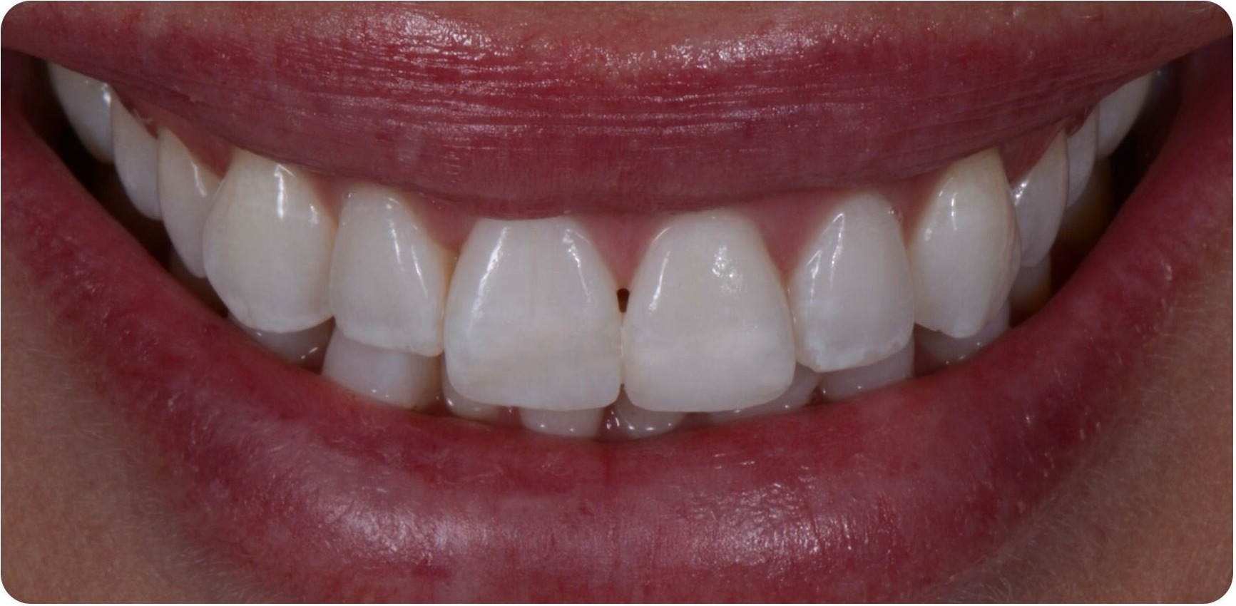 The same smile after treatment, with the upper edges even and balanced