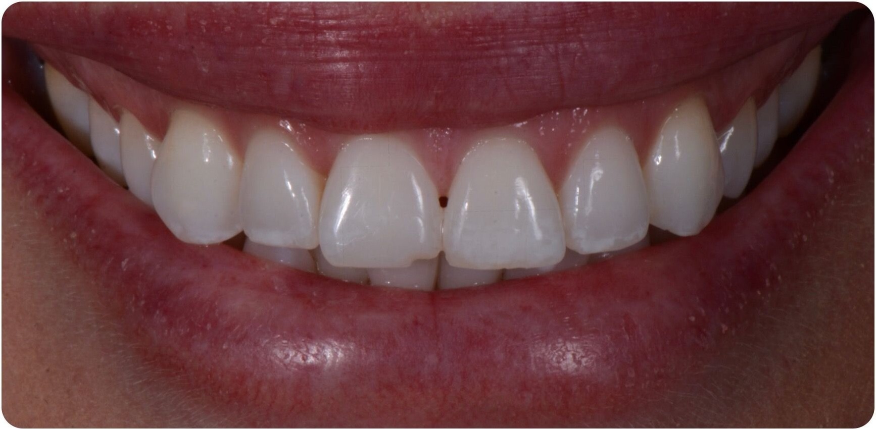 A smile before treatment, with slightly translucent and unevenly worn upper incisal edges
