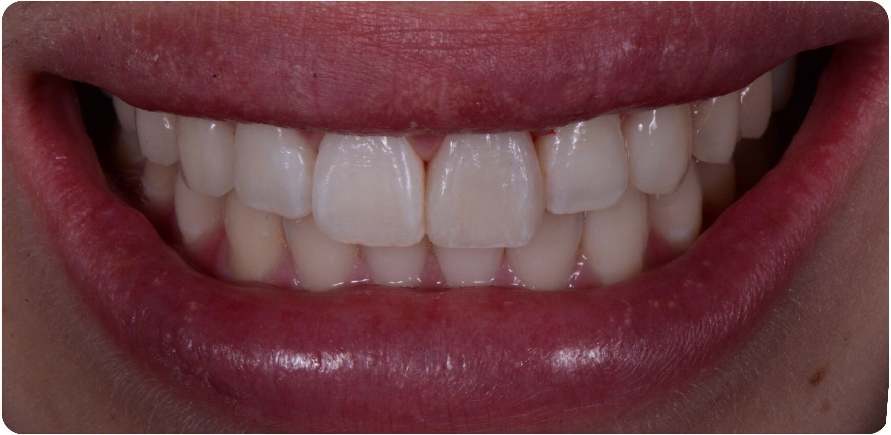 The same front tooth rebuilt to match the one beside it, after treatment