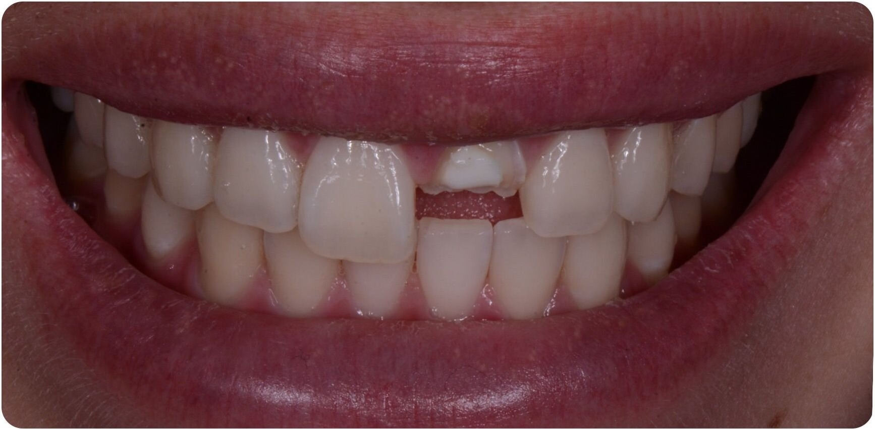 A front tooth fractured across half its width, before treatment