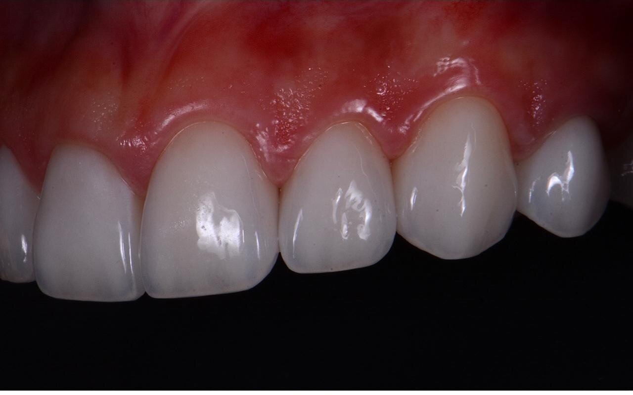 The same upper front teeth after treatment, matched in shade with natural surface texture