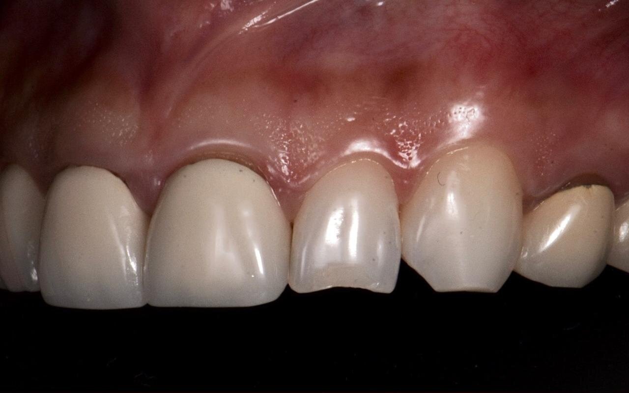 Close view of upper front teeth before treatment, with restorations that do not match in shade