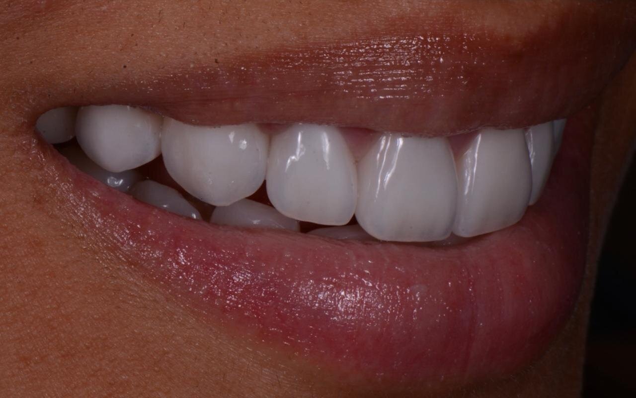 The same upper teeth after treatment, even across the arch