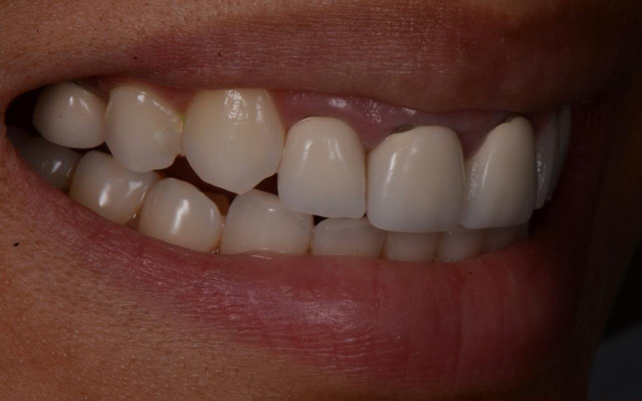 Side view of upper teeth before treatment, with worn edges and an uneven gumline
