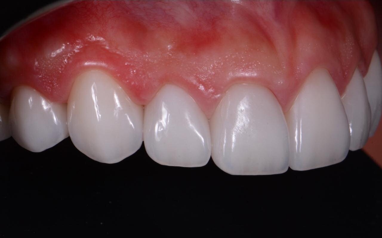 The same upper front teeth after treatment, even in shade with a symmetric gumline
