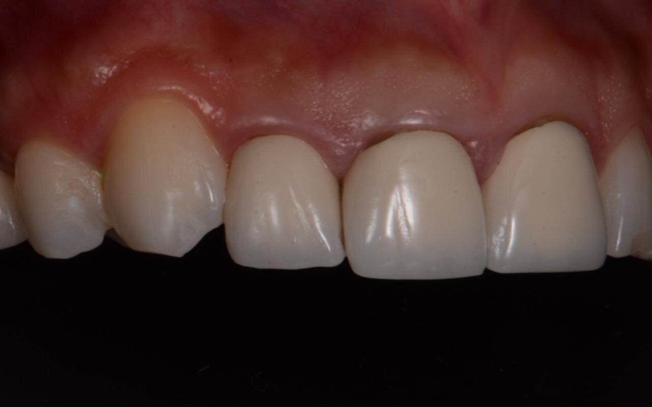 Close view of upper front teeth before treatment, uneven in shade and edge shape