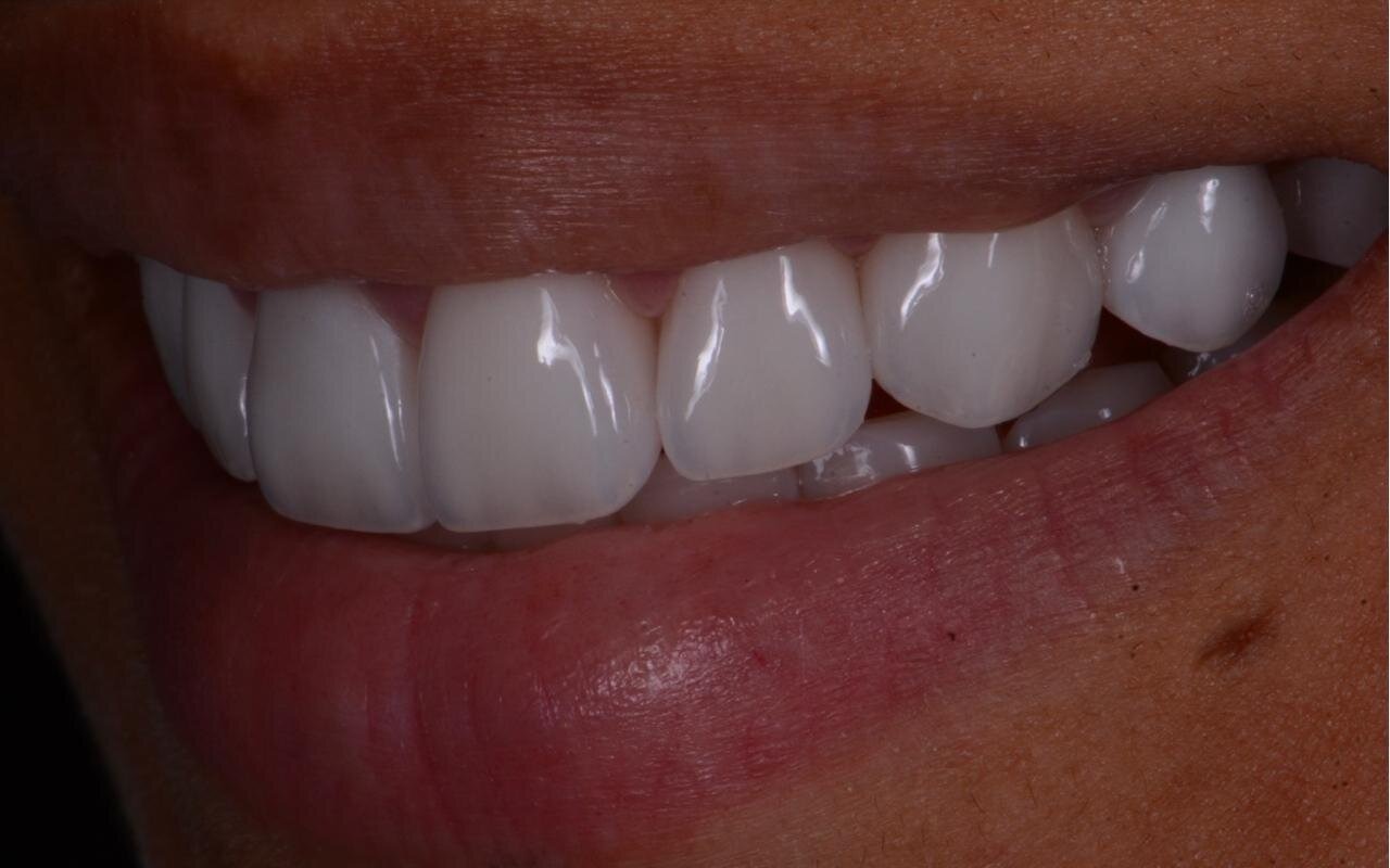 The same smile after treatment, even and natural in tone