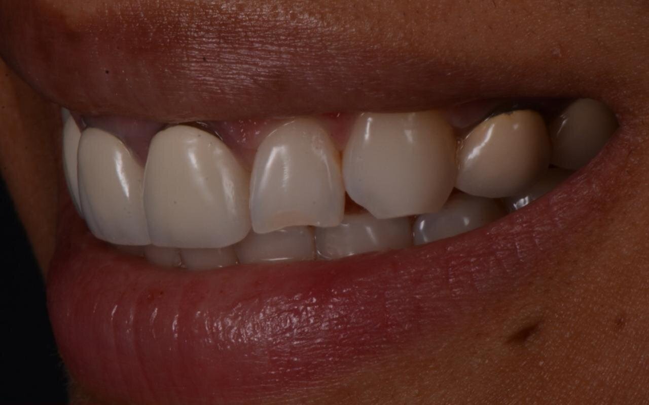 Three quarter view of a smile before treatment, with uneven and discoloured upper teeth