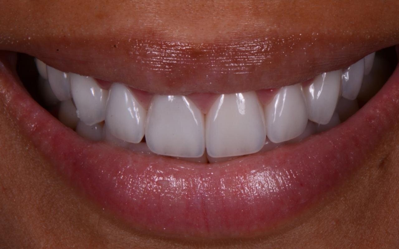 The same smile after treatment, even in proportion