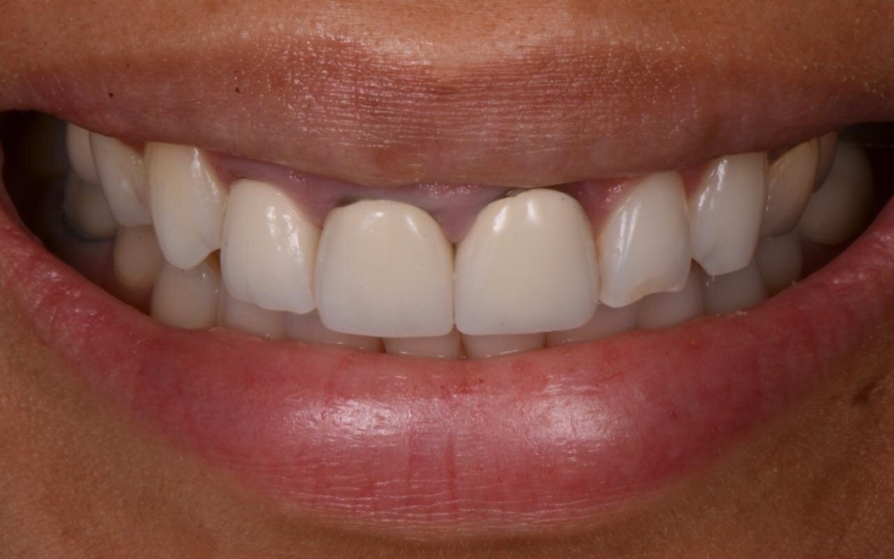 Front view of a smile before treatment, with worn and uneven upper edges